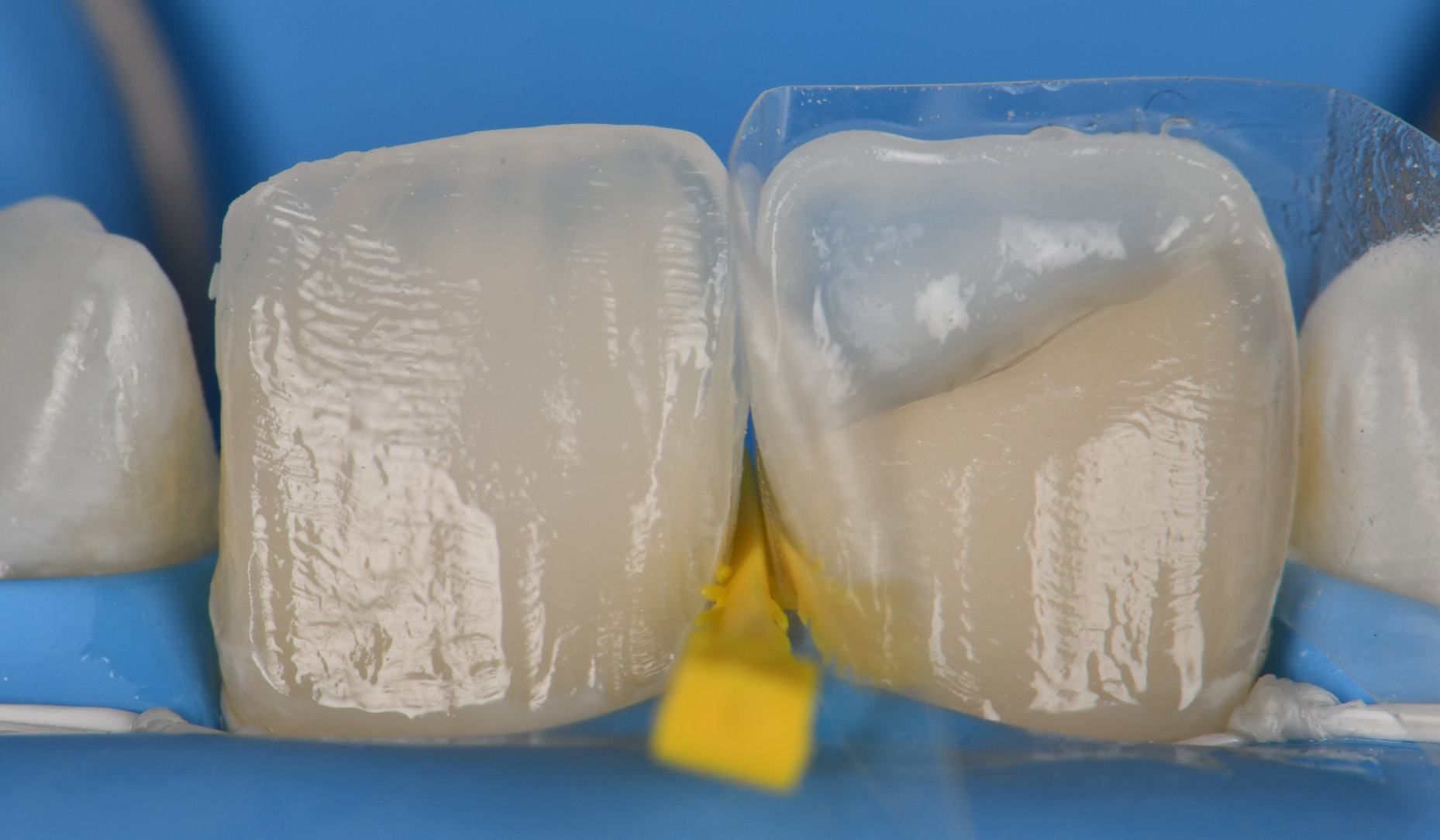 Figure 2: Controlling structure removal with UV light, which nicely reveals the old composite.